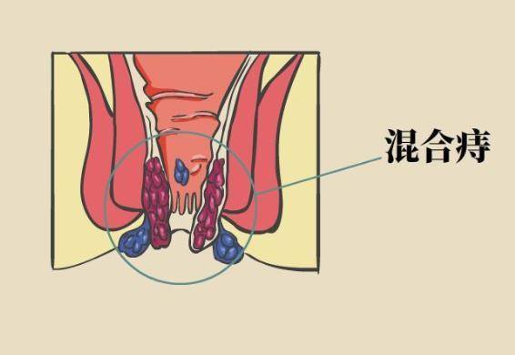 肛裂治疗最新方法概述