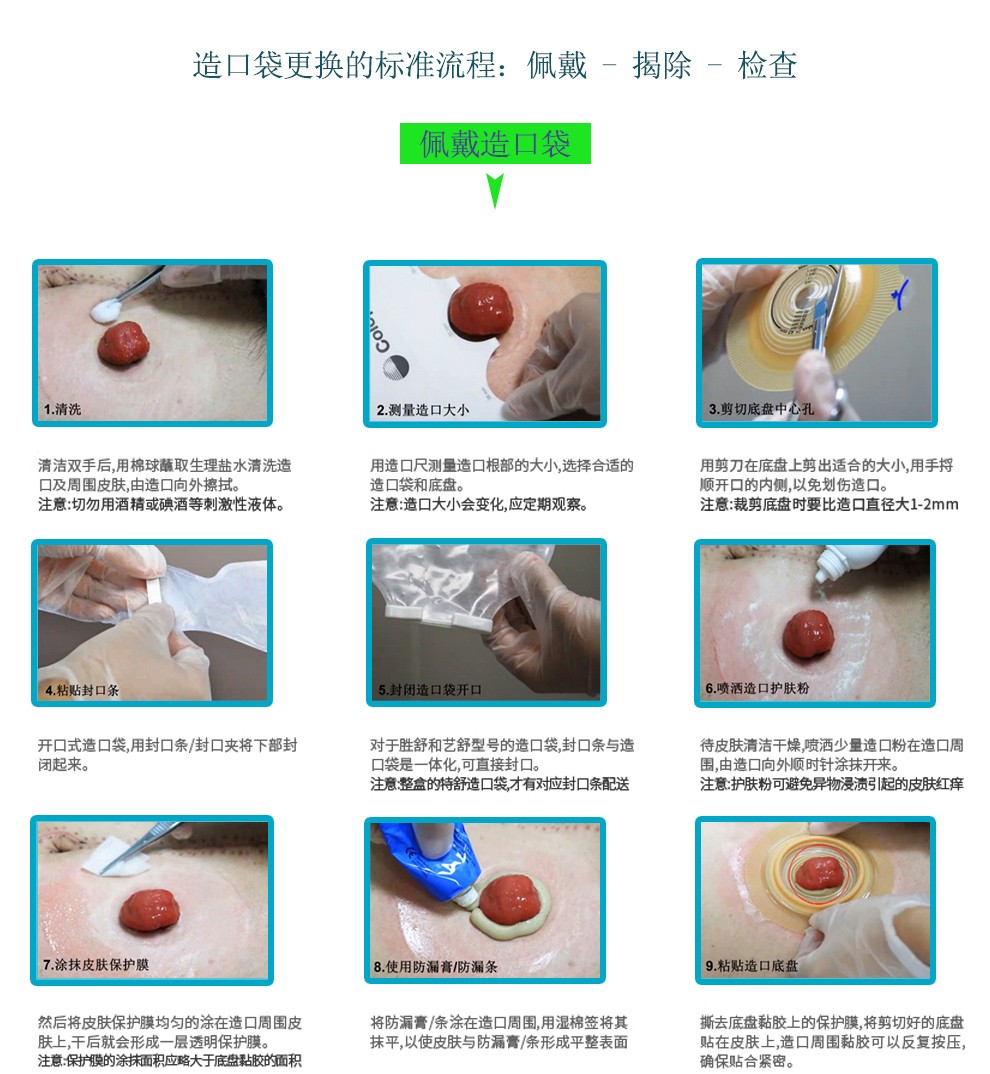 最新造口袋技术，医疗革新助力生活质量提升