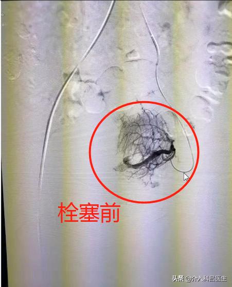 腺肌症最新治疗技术与方法探索